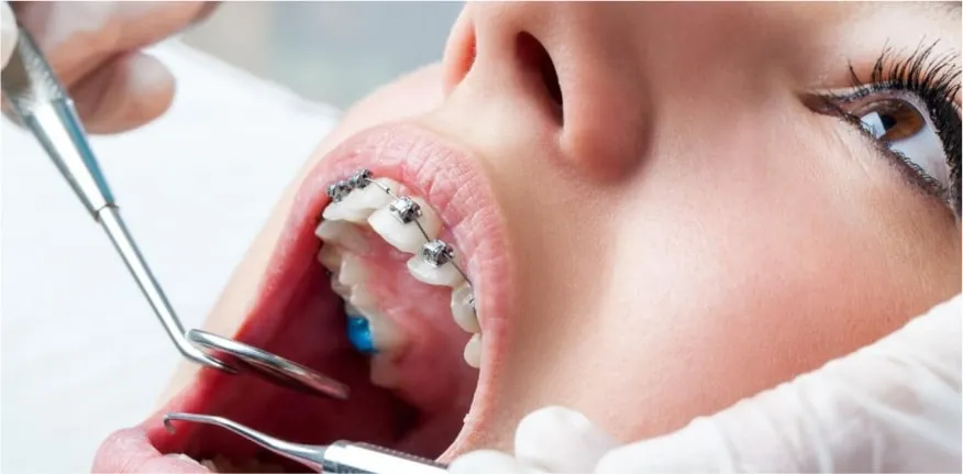 Ortodontik Tedavi Resim